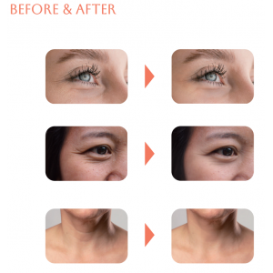 EYEBELLA rejuvenation with polynucleotide 1% - 1syr*2ml S.Korea EYEBELLA rejuvenation with polynucleotide 1% - 1syr*2ml S.Korea